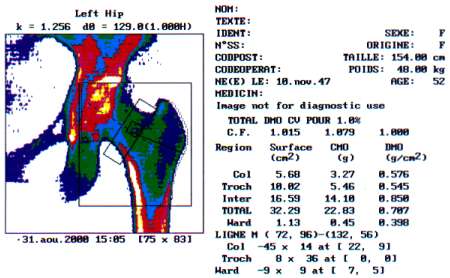 L'image de la hanche gauche obtenue aprs le balayage bi-photonique de cette rgion